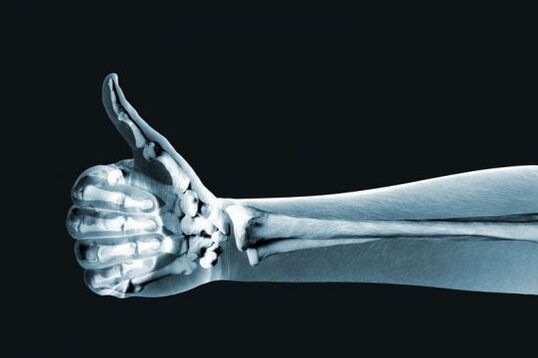 X-ray to diagnose pain in the joints of the fingers