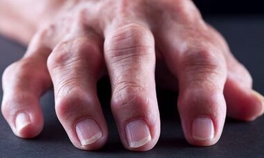 What is the difference between arthritis from arthritis