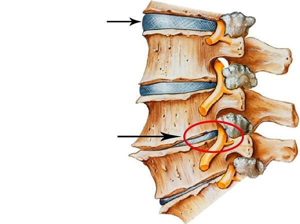 Disordis disorders in the intervertebral discs