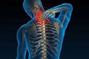 Osteochondrosis of the cervical leads to pain in the neck