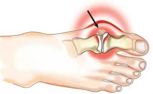 Inflammation of the joint between the big toe and the foot due to arthritis