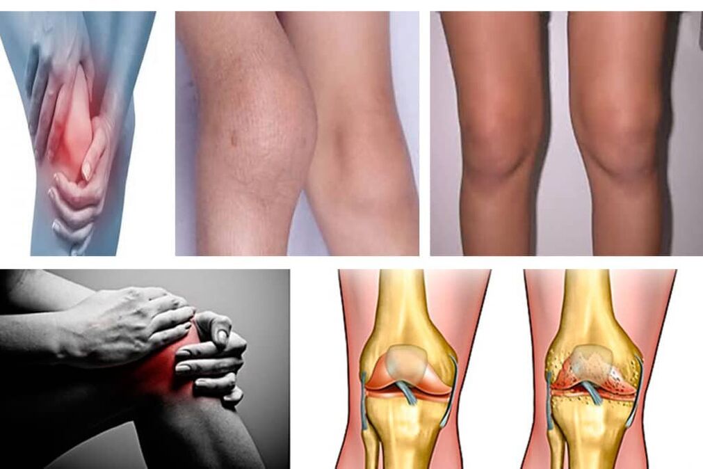 arthrosis, what is it