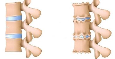 How to know the presence of Lumbari's osteochondrosis