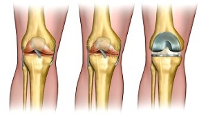 arthroplasty for osteoarthritis of the knee